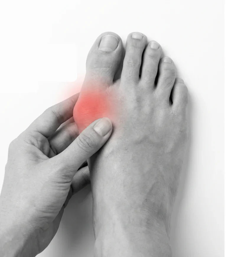 Hallux valgus