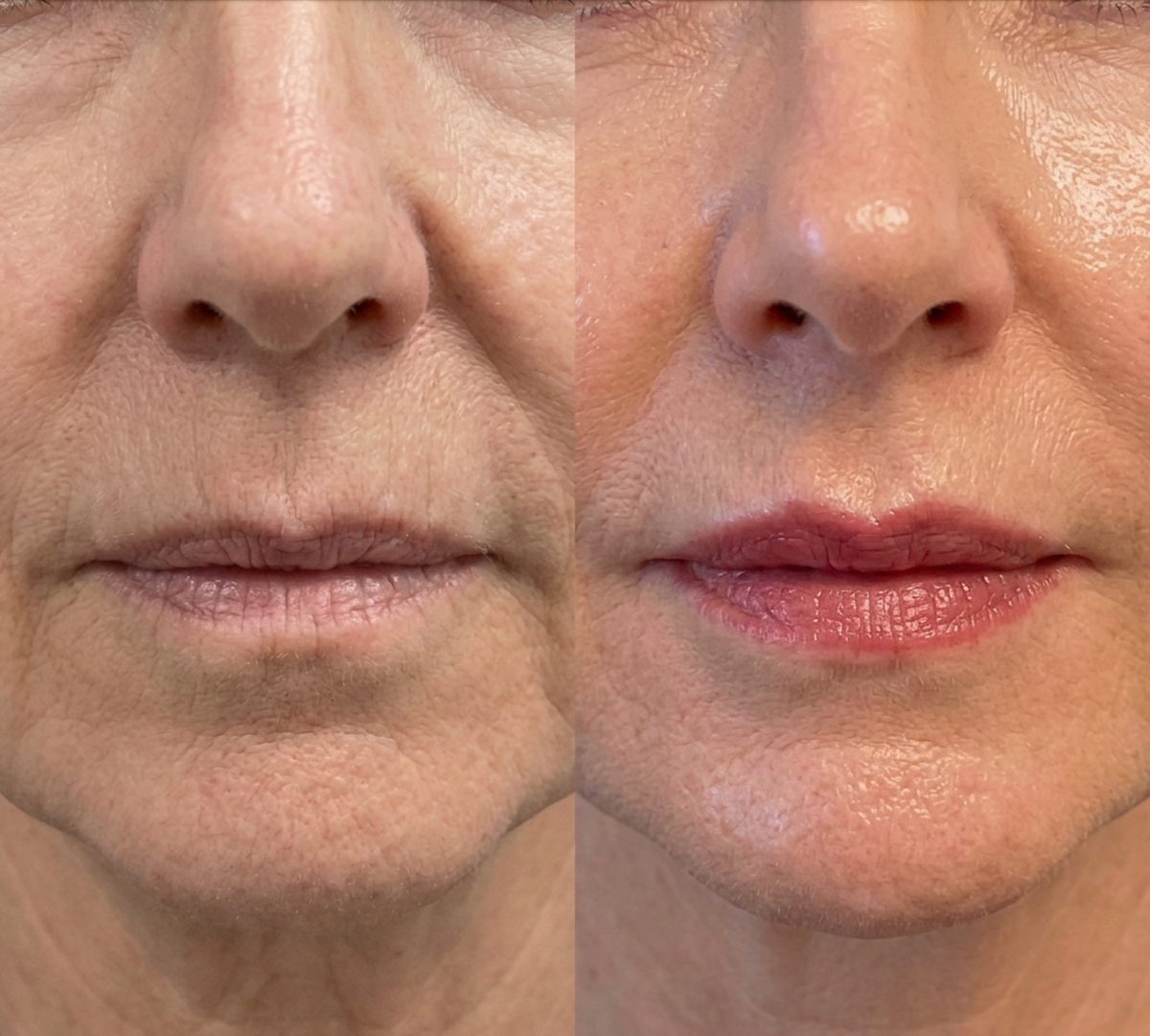 Volume Lip Gloss – För Små & Torra läppar